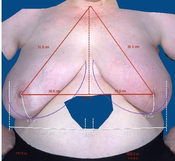 A comparison of volume and anthropometric breast measurements