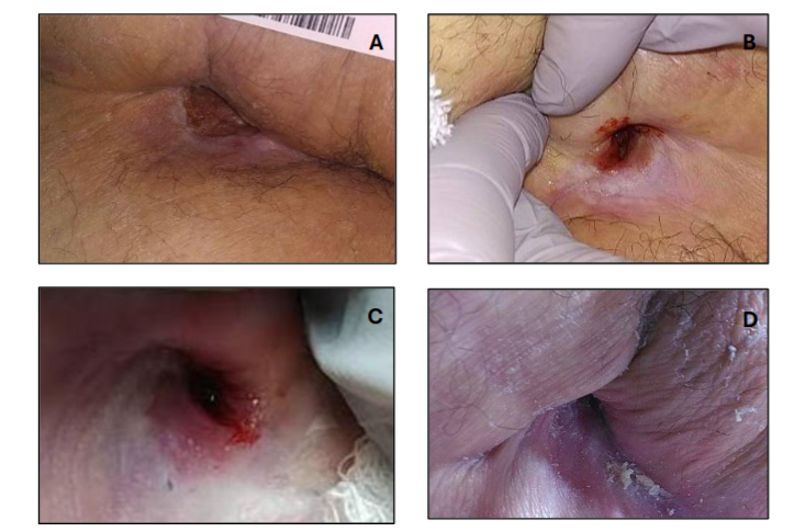 Figure 3. Stage IV sacral pressure ulcer (Case 3). Serial photographs show baseline (A, initial evaluation), treatment initiation (B, Day 1: first application), interval improvement (C, Day 35: fourth application), and complete epithelial closure (D, Day 42) following serial 3D-ACM applications.
