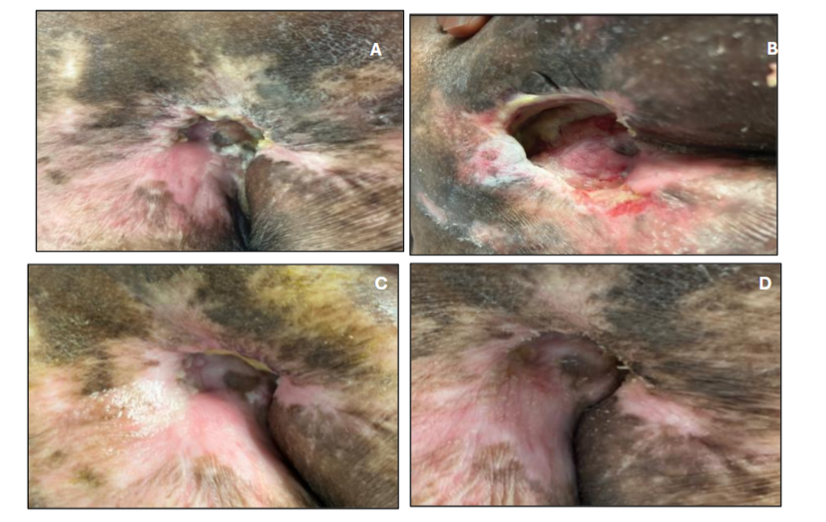 Figure 2. Chronic plantar DFU with exposed tendon. Serial photographs show baseline (A, Week 0), interim improvement (B, Week 4), progressive granulation with 90.3% PAR (C, Week 8), and complete epithelial closure (D, Week 13) following serial 3D-ACM applications with offloading and standard dressing care.