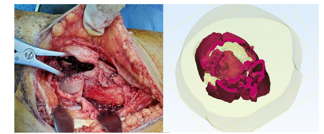 Figure 4. A 3D see-through 360-degree cross-section of the left Pilon fracture clearly showing embedded broken pieces in the region of interest, in contrast to the open ROI during the surgical operation. Reference: ADAN Hospital- KW.