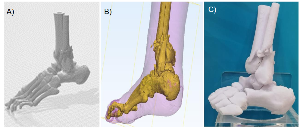 Figure 3. A 54-year-old female with a left Pilon fracture: (a-b) 3D digital fracture prototype, including soft tissue and fat; (c) Corresponding 3D-printed, 1:1 scale solid prototype of the left Pilon fracture in the 54-year-old female.