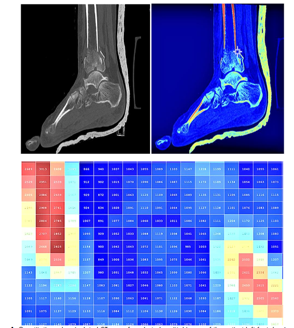 Figure 1. Quantitative color pixelated CT map of a selected sagittal image of the patient left foot showing various density level of the broken ankle. Reference: ADAN Hospital- KW