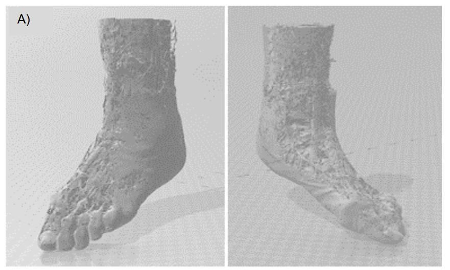Figure 2. A 54-year-old female with a left Pilon fracture who underwent open reduction and internal fixation. A global 3D computer model was generated and used for preoperative planning: (A-B-C) Three-dimensional reconstructions of muscles, soft tissues, and hard bone created using Materialize Mimics Research software; (D) Postoperative X-ray showing internal fixation.
