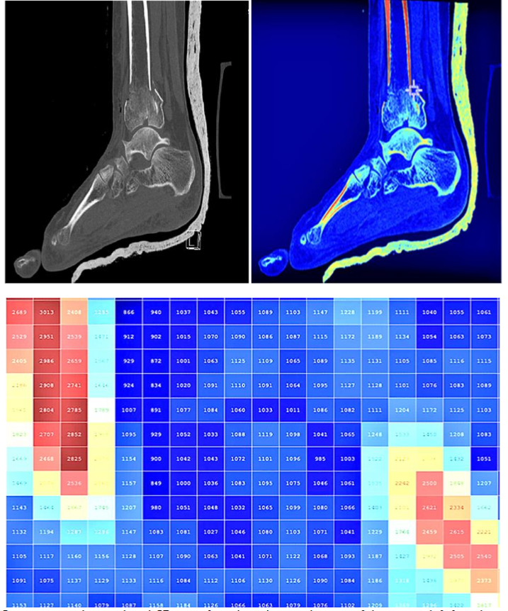 Figure 1. Quantitative color pixelated CT map of a selected sagittal image of the patient left foot showing various density level of the broken ankle. Reference: ADAN Hospital- KW