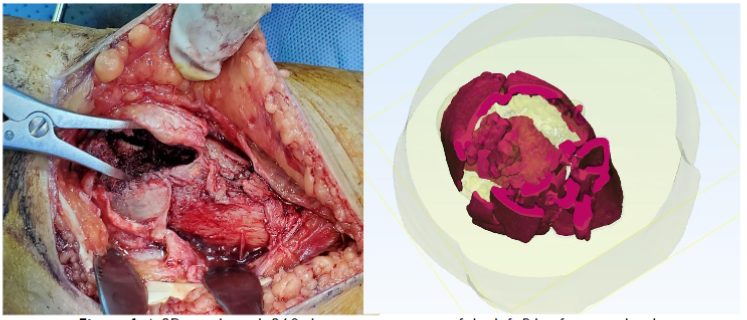 Figure 4. A 3D see-through 360-degree cross-section of the left Pilon fracture clearly showing embedded broken pieces in the region of interest, in contrast to the open ROI during the surgical operation. Reference: ADAN Hospital- KW.