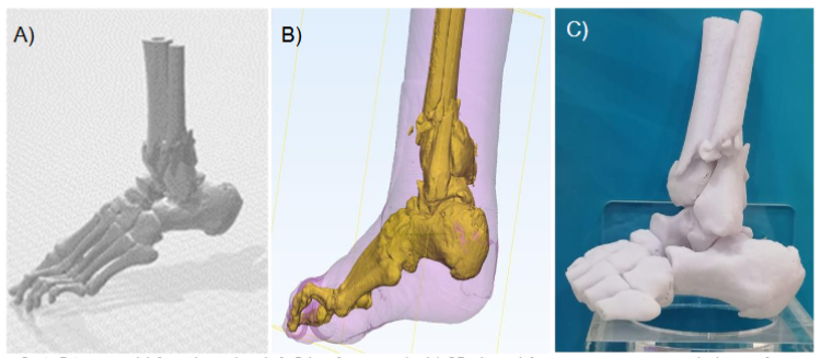 Figure 3. A 54-year-old female with a left Pilon fracture: (a-b) 3D digital fracture prototype, including soft tissue and fat; (c) Corresponding 3D-printed, 1:1 scale solid prototype of the left Pilon fracture in the 54-year-old female.