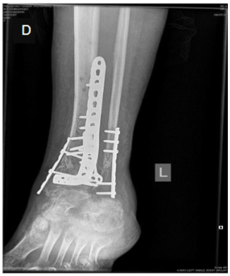 Figure 2. A 54-year-old female with a left Pilon fracture who underwent open reduction and internal fixation. A global 3D computer model was generated and used for preoperative planning: (A-B-C) Three-dimensional reconstructions of muscles, soft tissues, and hard bone created using Materialize Mimics Research software; (D) Postoperative X-ray showing internal fixation.