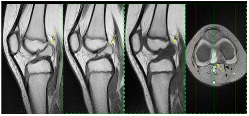 Simple MRI of the right knee. Yellow date ganglion
