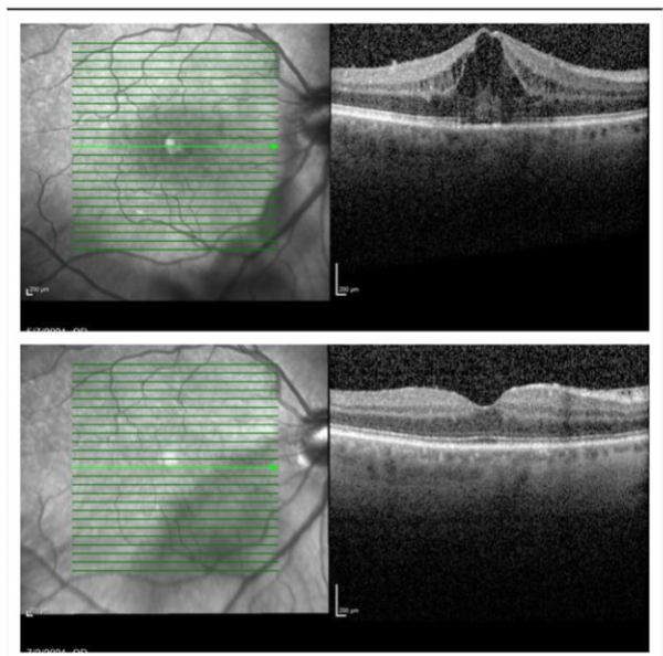 Figure 1: Top: Cystoid macular edema (CME) upon presentation. Bottom: Resolution of CME one month after treatment with topical corticosteroids.