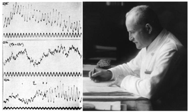 Fig. 6. Hans Berger (1873-1941) in 1927 with the ‘Elektrenkephalogramm’ of his daughter Ilse. Upper trace: Ilse in rest (alpha waves), middle trace: Ilse in calculating a sum (beta waves), and lower trace: Ilse in giving the result of the sum (mixed waves).