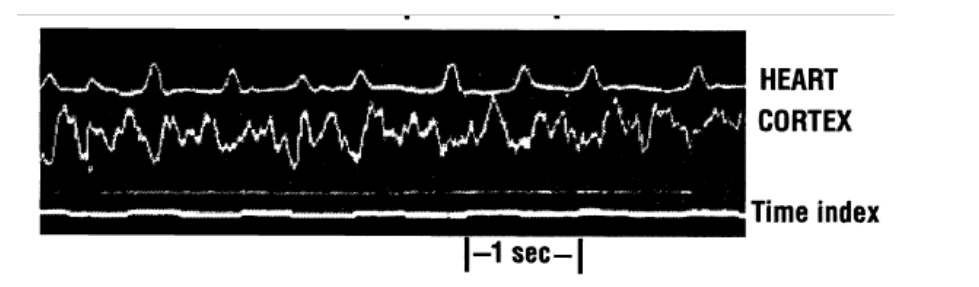 Fig. 9. The first photograph of a focal-epileptic seizure recorded in the cerebral cortex of a dog. The spontaneous oscillations in the bottom trace have a frequency of approximately 3 Hz. The recording is made by Cybulski and Jeleńska-Macieszyna in 1914.