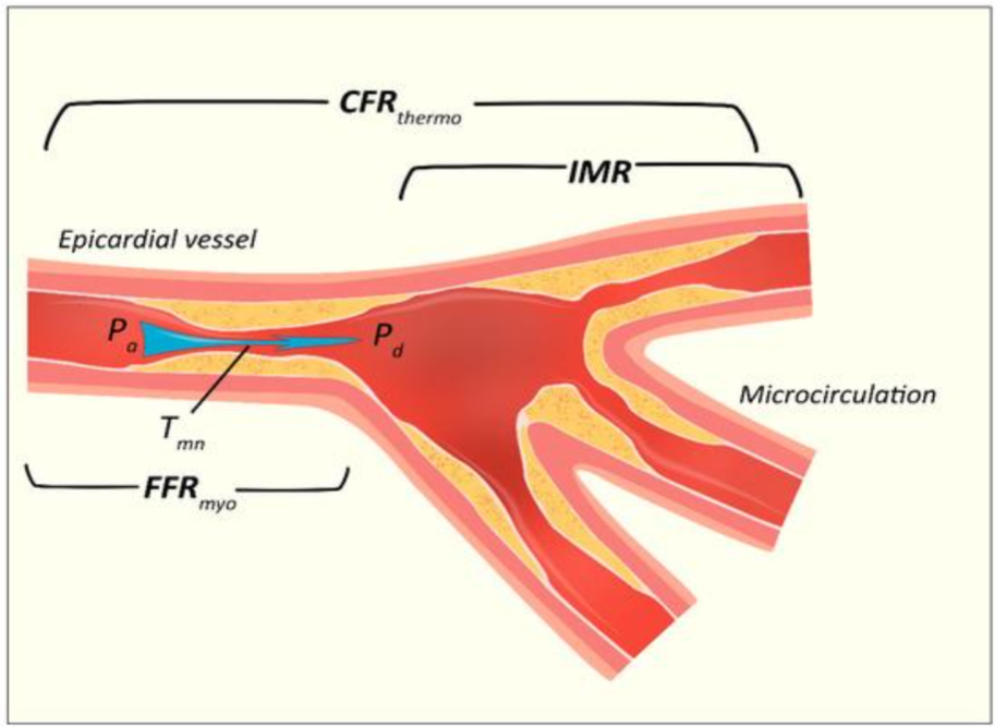 Figure 1. Invasive Assessment of the Coronary Microvasculature. CFRthermo = coronary flow reserve derived from thermodilution; IMR = index of microcirculatory resistance; Pa = mean proximal coronary pressure; Pd = mean distal coronary pressure; Tmn = mean transit time; FFRmyo = fractional flow reserve (specific to myocardial blood flow).