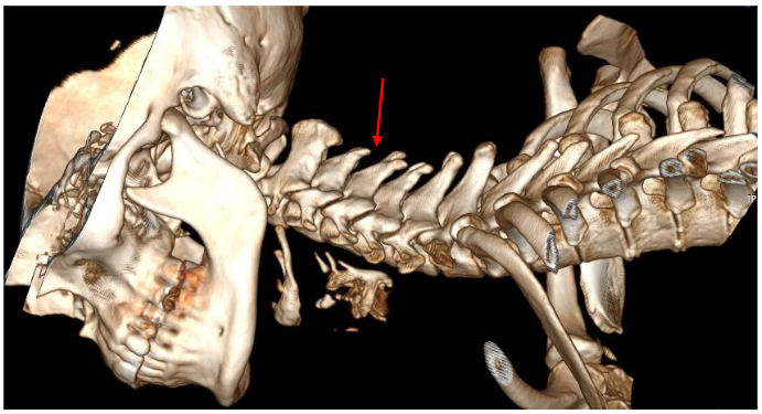 Figure 2: CT, 3D, lateral view C0-1-2, left side. Neutral head and neck position.
