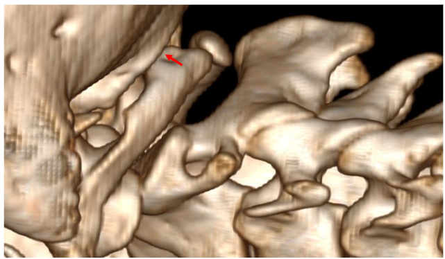 Figure 3: MRI, 3T, coronal T2-weighted images.