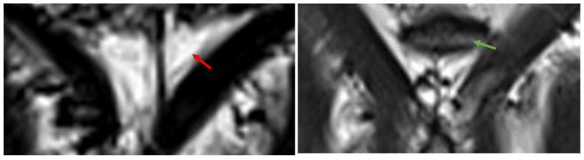 Figure 4: CT, 3D, lateral view C1-2. The left arrow shows the left-side bow-end inside foramen magnum.