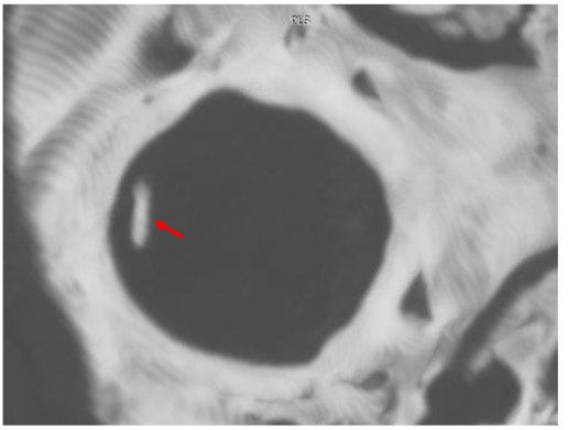 Figure 5: MRI, 3T, T2-weighted sagittal TSE at the level of the upper part of the dens axis-alis. The right picture shows the upper part of dens axis-alis.