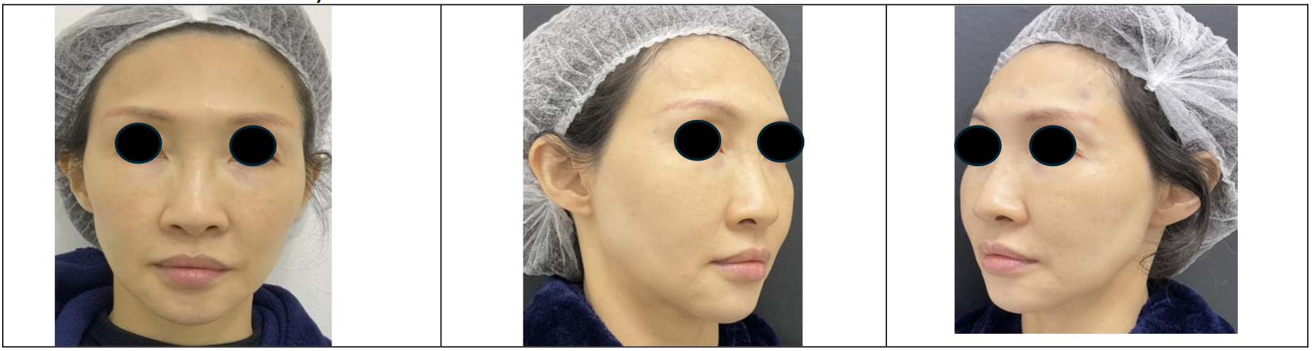 Figure 1a: Frontal and Oblique Views in May 2024, after the most recent comprehensive facial treatment with dermal fillers as described in Table 1.