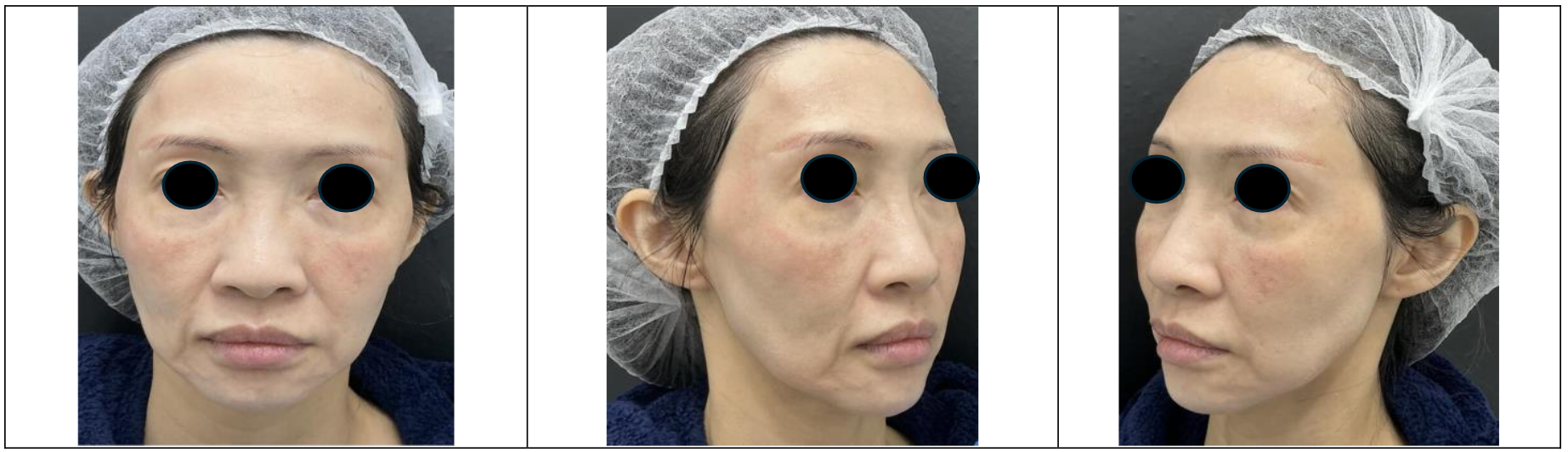 Figure 1b: Frontal and Oblique Views in September 2024, after full face hyaluronidase treatment in preparation for Fat Transfer.
