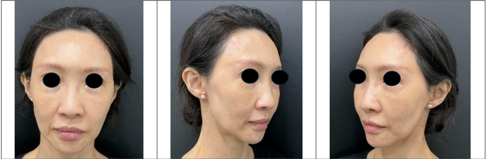 Figure 1c: Frontal and Oblique Views in November 2024, two months after receiving first full face fat transfer treatment.