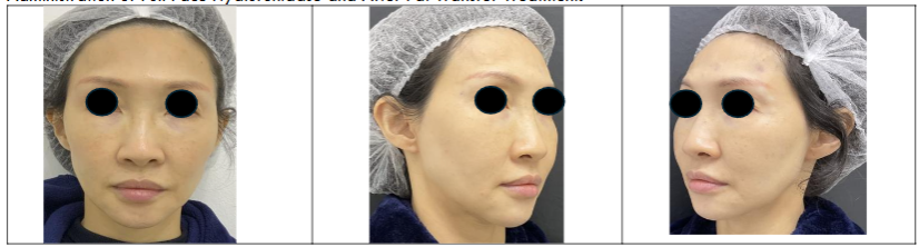 Figure 1a: Frontal and Oblique Views in May 2024, after the most recent comprehensive facial treatment with dermal fillers as described in Table 1.