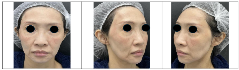 Figure 1b: Frontal and Oblique Views in September 2024, after full face hyaluronidase treatment in preparation for Fat Transfer. Existing dermal fillers were dissolved to inform accurate fat volume requirements for fat transfer procedure.
