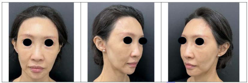Figure 1c: Frontal and Oblique Views in November 2024, two months after receiving first full face fat transfer treatment.
