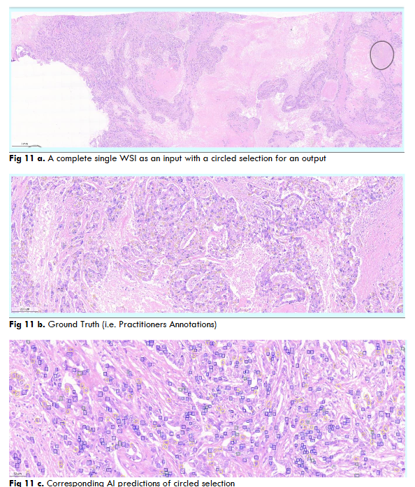 Fig 14. Output result of Breast Cancer NP Grade 1 through Grade 4 - Tiles wise