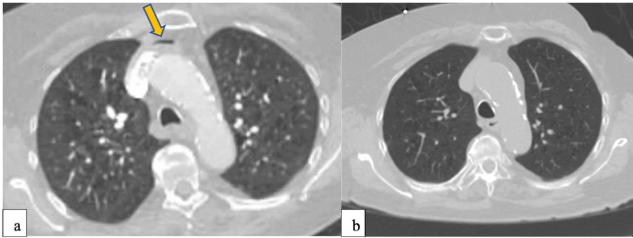 Figure 2- (a) CTPE study demonstrating air embolism in left brachiocephalic vein (arrow). (b) CT non-contrast 3 days later showing resolution of air embolism. (Adopted from Poster-Incidental Finding of Air Embolism in Left Brachiocephalic Vein After Contrast Injection, Garg et. Al, Am J Respir Crit Care Med 2023;207:A5512)