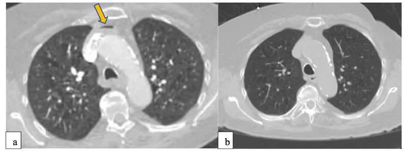 Figure 2- (a) CTPE study demonstrating air embolism in left brachiocephalic vein (arrow). (b) CT non-contrast 3 days later showing resolution of air embolism. (Adopted from Poster-Incidental Finding of Air Embolism in Left Brachiocephalic Vein After Contrast Injection, Garg et. Al, Am J Respir Crit Care Med 2023;207:A5512)