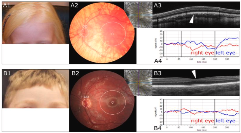 Fig. 2. Clinical presentation of two patients with albinism.