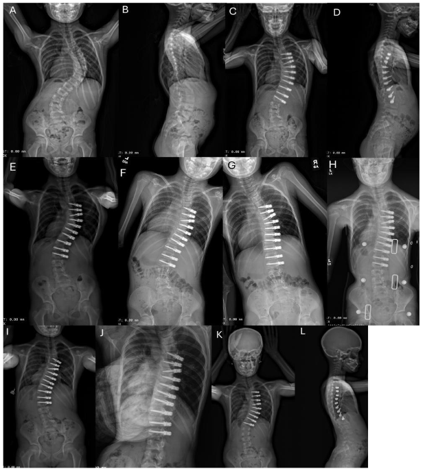 Fig. 2A-L. Example of unilateral thoracic ASC with intervertebral de-tethering releases.