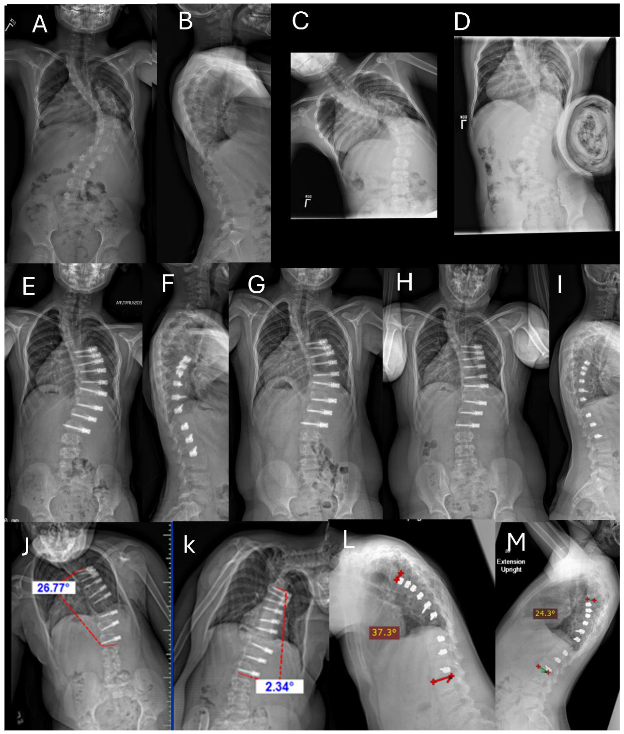 Fig. 1A-M. Example of unilateral instrumented thoracic curve over a period of 60 months postoperative. See Section 3.2 Case History for Figure 1.