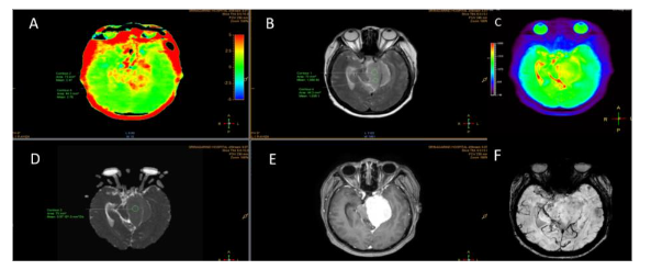Figure 4: Meningioma, meningothelial variant (WHO grade I): APT mean and APT max = 2.76, ADC value = 0.95 and ADC ratio = 1.22 (A) APT-weighted image shows increased APT signal at the left tentorial mass, ROIs were placed at the highest APT signal area corresponding to the S0 image (C) (B) T2-weighted image and (E) contrast-enhanced T1-weighted image show enhanced mass at the left tentorium in keeping with meningioma (D) ADC maps with ROIs placed at the meningioma (F) SWI shows no internal calcification or hemorrhage.
