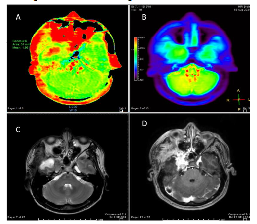 Figure 1: Meningioma, meningothelial variant (WHO grade I) (A): APT image shows increased APT signal of the right cavernous sinus in red color (B): S0APT image shows corresponding slightly increased APT signal area at the right cavernous mass. Area of red color consistent with artifact at skull base. (C): T2-weighted image and (D): contrast-enhanced T1-weighted image shows meningioma of right cavernous sinus.