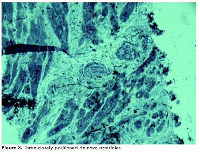 Figure 3. Three closely positioned de novo arterioles.