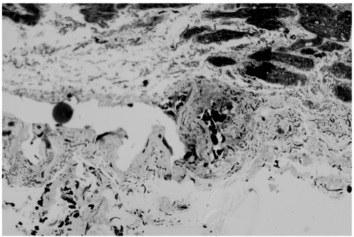 Pic. 2: Vascular convolution formation. x40 Score 3