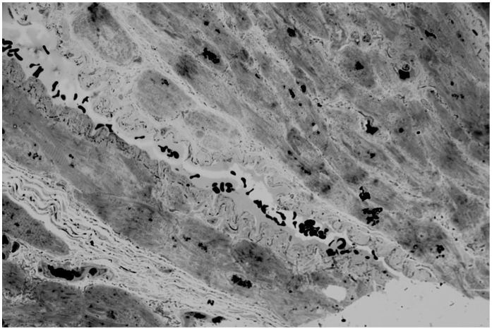 Pic.1: Invagination of one of the vessel walls into the lumen. Bridge formation. X40 Score 3