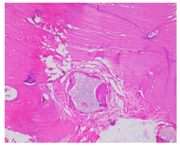 Figure 1: Dentin matrix graft material surrounded by mature bone trabeculae (H and E, 10x)