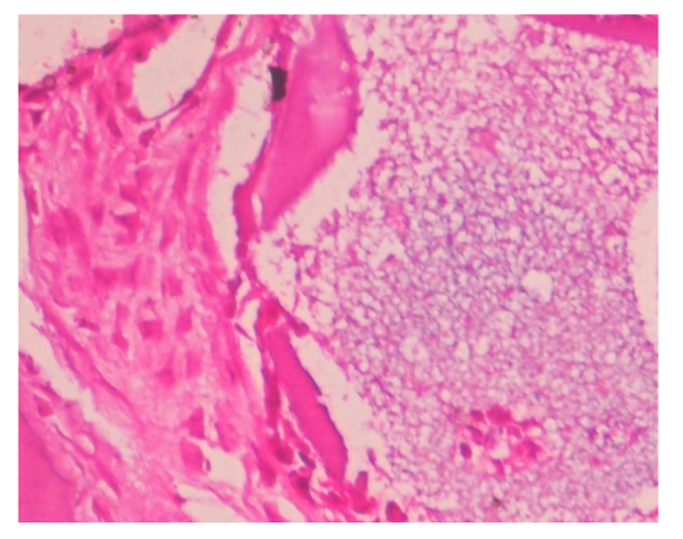 Figure 2: Bone induction by the graft material, osteoblastic differentiation appreciated (H and E, 40x)