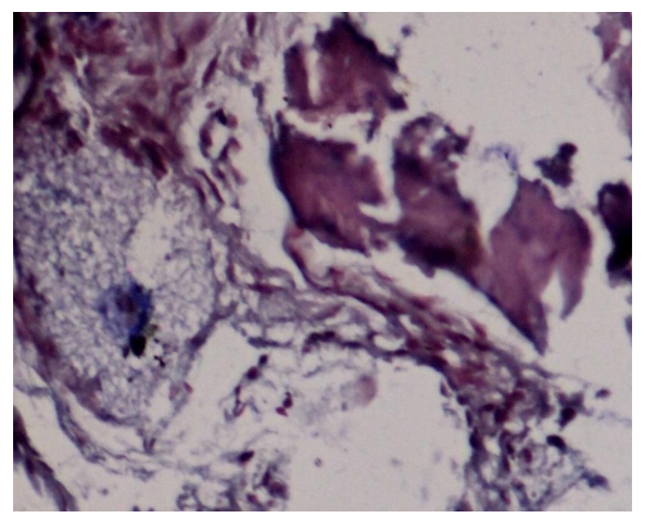 Figure 5: Bone induction observed under Massons trichrome, green hue of graft material and red coloured mature bone (40x)