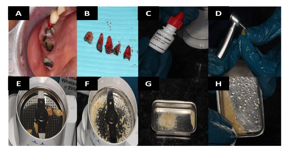 Figure 6: A) Grossly decayed teeth in the posterior area of first quadrant, B) Freshly extracted teeth specimen, C) Dentin cleanser composed of Sodium Hydroxide and 20% ethanol, D) Removing the top layer of tooth surface, E) Dentin Grinder Machine, F) Grinding of tooth substance by Dentin smart grinder, G) Autograft, H) Graft material mixed with saline