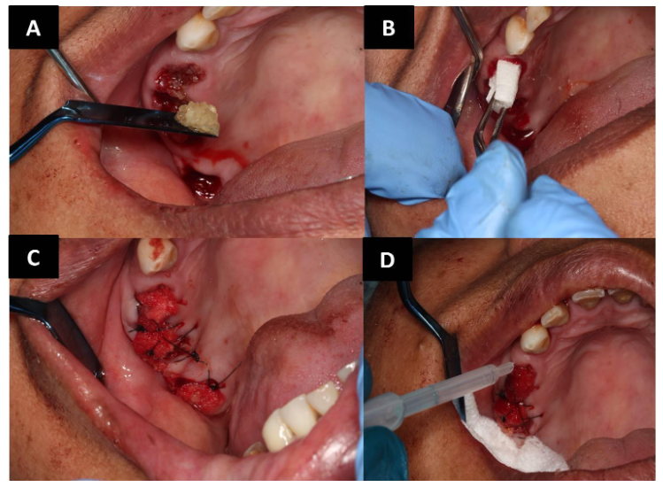 A) Packing of dentin material into socket, B) Placement of Rapiplug collagen membrane, C) Suturing the soft tissue, D) Application of tissue adhesive (PeriAcryl, GluStitch Inc, Delta, BC, Canada)