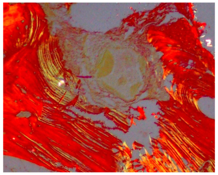 Figure 4: Bone induction under Polarizing microscope, Yellow birefringence of graft material and Red lamellated pattern of mature bone (10x)