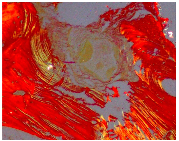 Bone induction under Polarizing microscope, Yellow birefringence of graft material and Red lamellated pattern of mature bone (10x)
