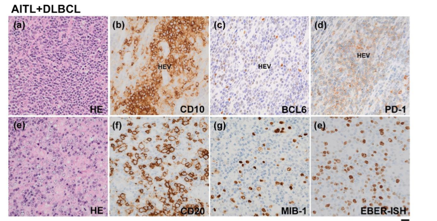 Figure 2: Diagnosis of AITL and DLBCL. (a)-(d): Diagnosis of AITL. Uniform round cells were clustered around HEVs. They were positive for CD10 and PD-1 and weakly positive for Bcl-6. (e)-(h): Diagnosis of DLBCL. Atypical CD20-positive cells showed high MIB-LI. EBV infection was also confirmed with EBER-ISH. Scale bar: 20 mm.