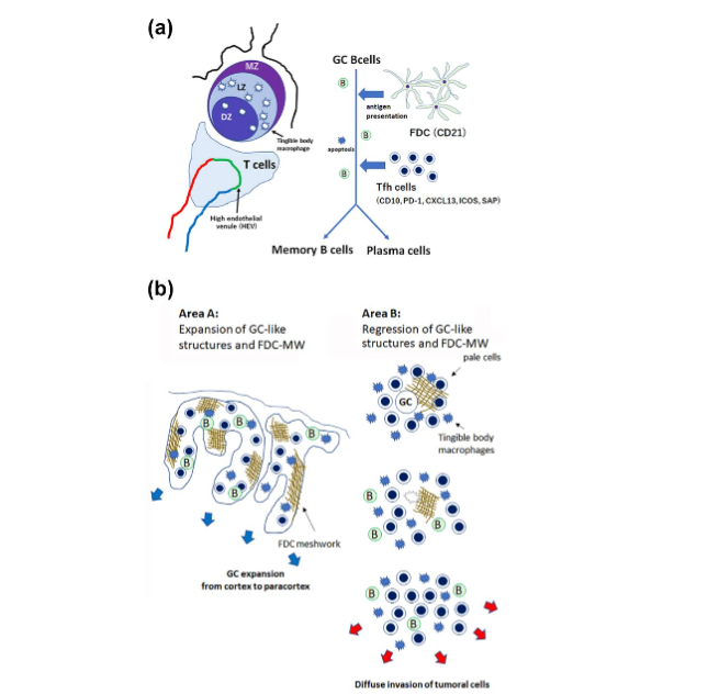 Figure 3: Hypothesis of DLBCL development from AITL lesions of Attygalle pattern II-III. (a) Schematic illustration of a reactive germinal center. GC B cells underwent an antigen presentation from FDC, and TFH cells help their maturation to memory B cells or plasma cells. (b) Schematic illustration of AITL area A and area B, described in Fig. 1. Area A (pattern I) showed expansive GC-like structures and FDC-MW, in which AITL cells and GC B cells were diffusely distributed. In contrast, area B (pattern II) showed regressed GC-like structures and FDC-MW, around which AITL cells and maturated B cells were expanded. DLBC cells were seen at the expansive margin of area B.