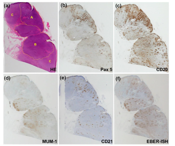 Figure 1: B-cell maturation in an AITL lymph node with secondary DLBCL. A normal lymph node architecture was disrupted, and divided into three areas, A, B, and C, corresponding to Attygalle patterns I, II, and III, respectively. Different areas showed distinct expression patterns of B cell maturation markers. (a) HE, (b) Pax 5, (c) CD20, (d) MUM-1, (e) CD21 (f) EBER-ISH.