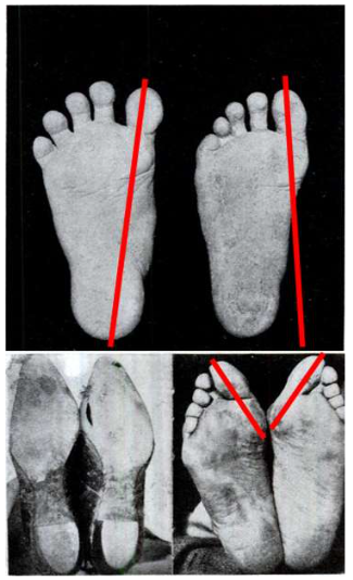 Improperly fitted footwear changes foot anatomy over time. Top left to right: the hallux angle (red lines) is markedly increased just from a few months of wearing shoes. Bottom: the effects are cumulative: over time, the foot will take up the shape of the shoe with its associated chronic health problems. These photographs were published in 1905.