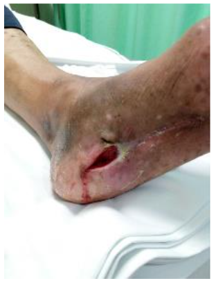 Male patient, 37 y.o., DM2 treated elsewhere initially.