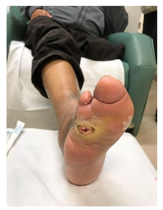 Complete wound healing in 7 weeks.